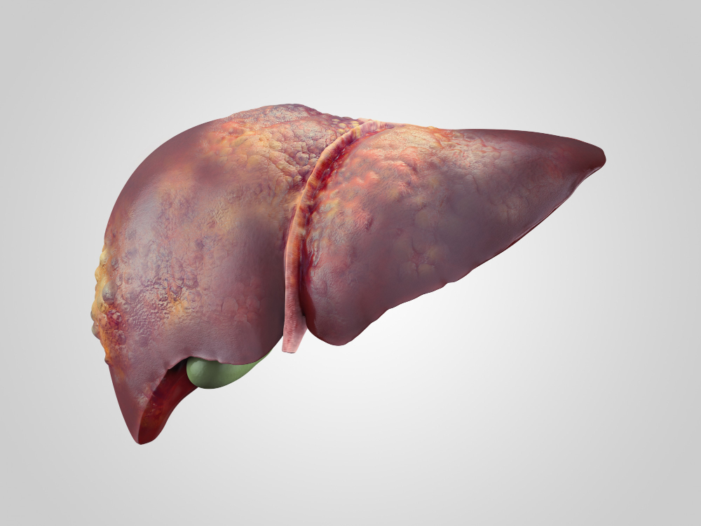 best ayurvedic Clinic for liver cirrhosis in vadodara gujarat