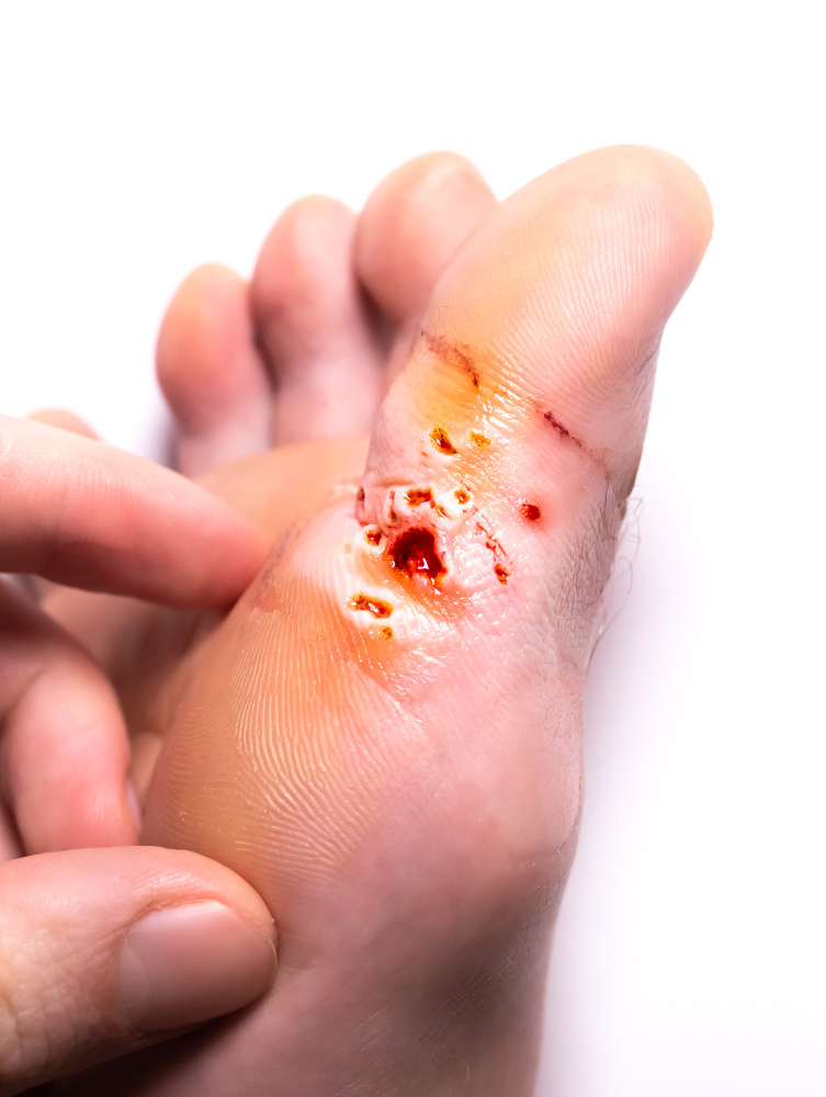 heal gangrene avoid surgery in vadodara