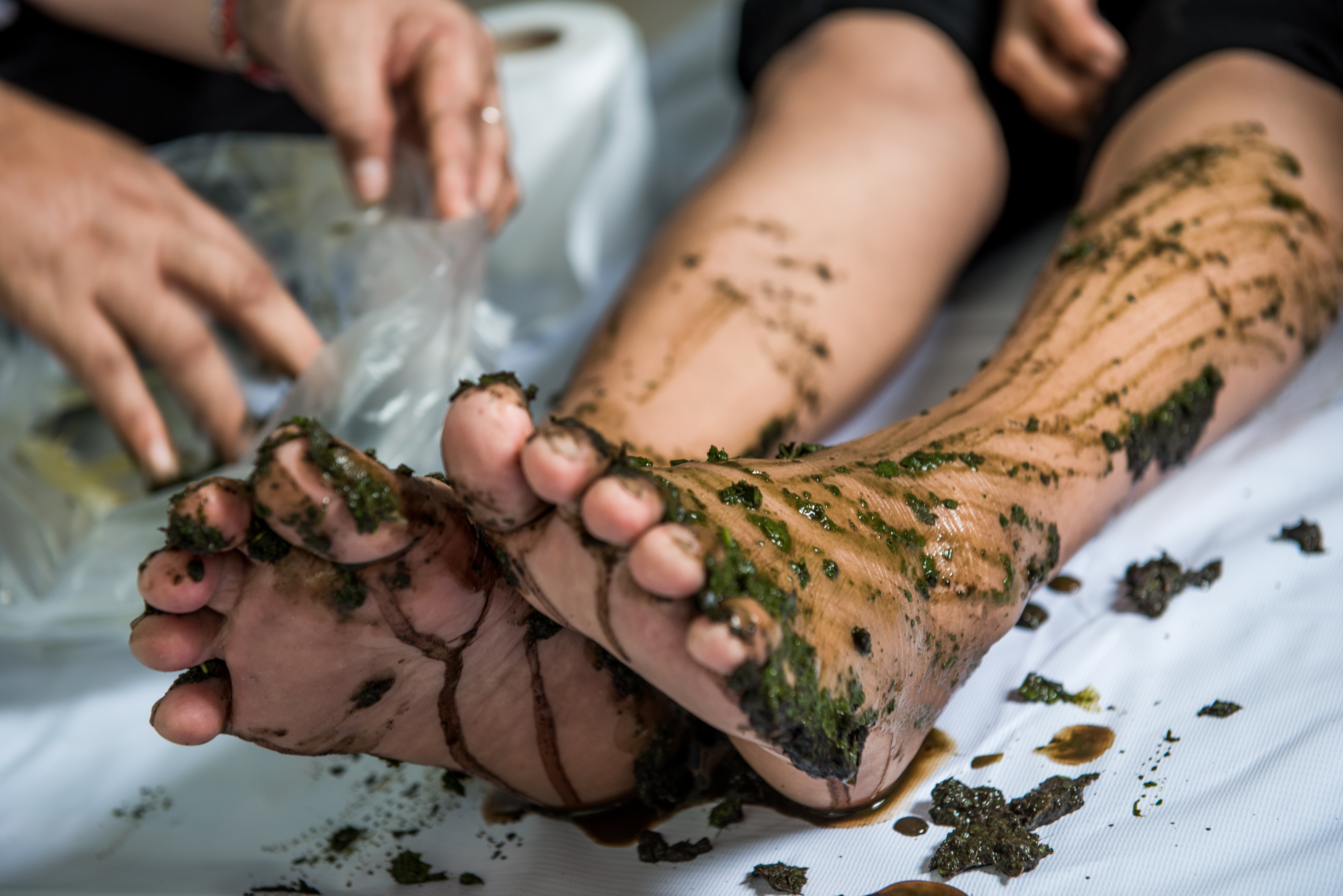 Heal Gangrene Without Surgery in vadodara