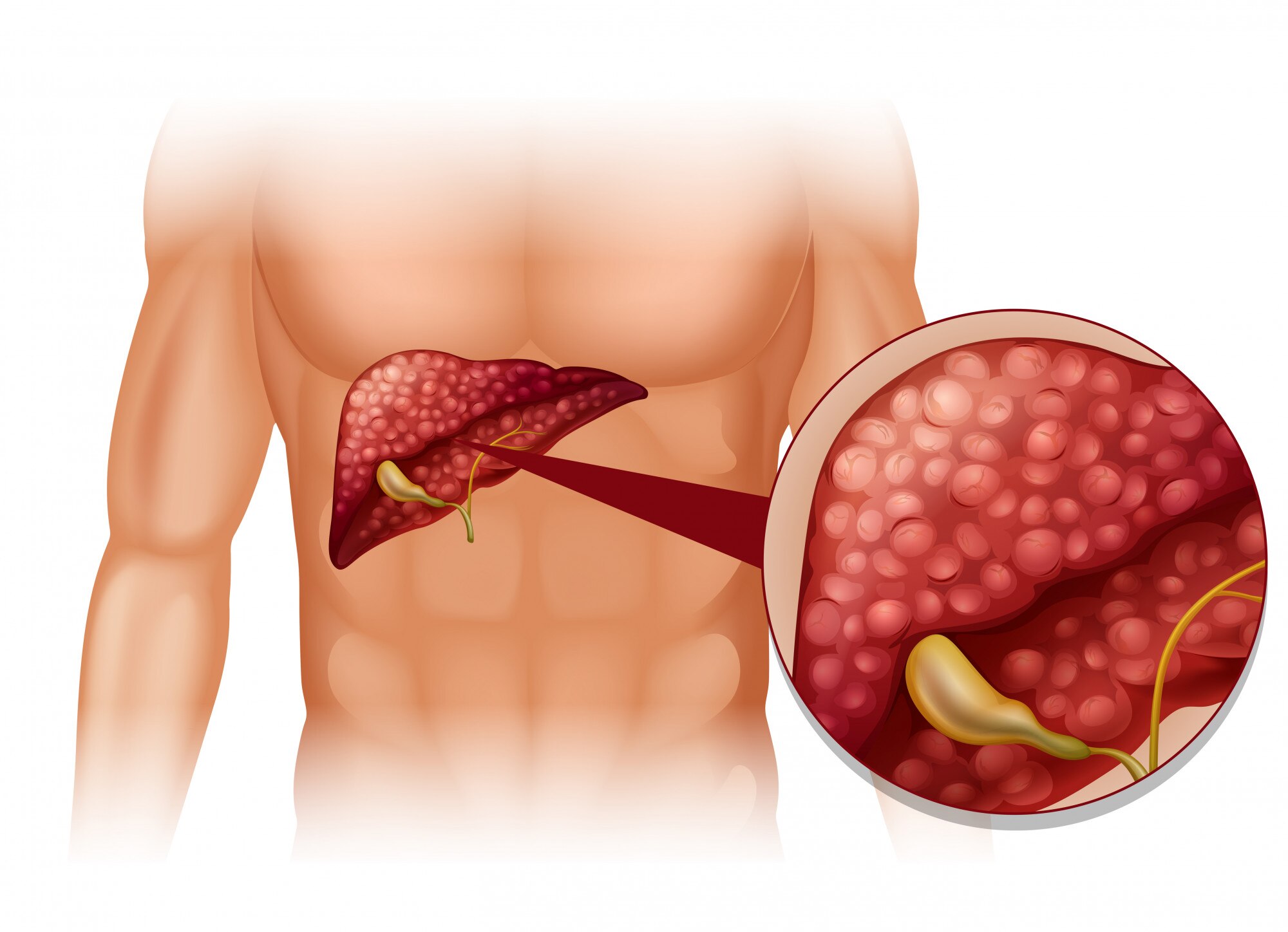liver cirrhosis in vadodara guajart